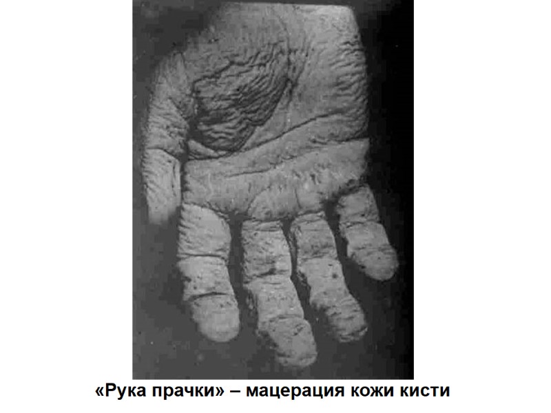 «Рука прачки» – мацерация кожи кисти